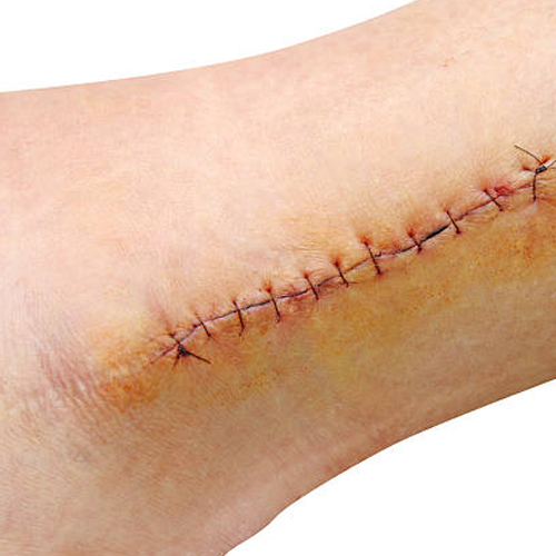 Abintra® Specialized Nutrition for Wound Healing